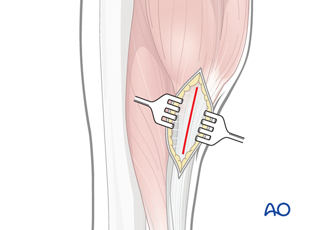 Subcutaneous dissection for release of the gastrocnemius equinus
