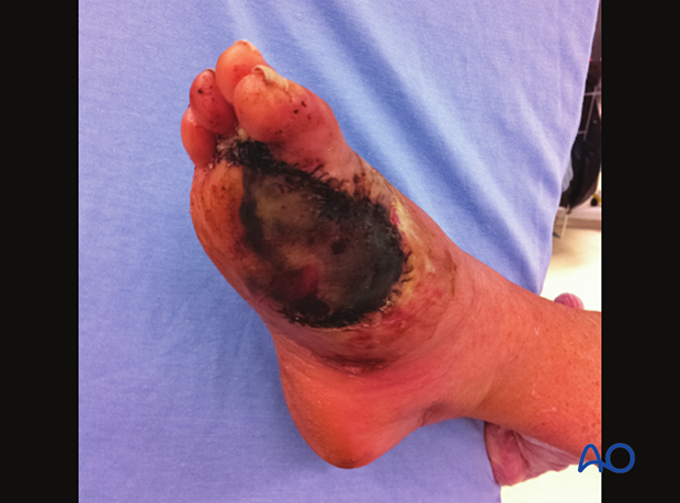 General swelling of the foot