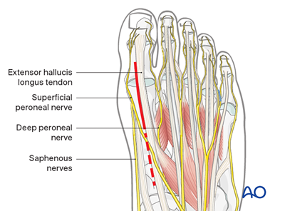 Dorsal approach to the 1st metatarsal phalangeal joint (MTPJ)