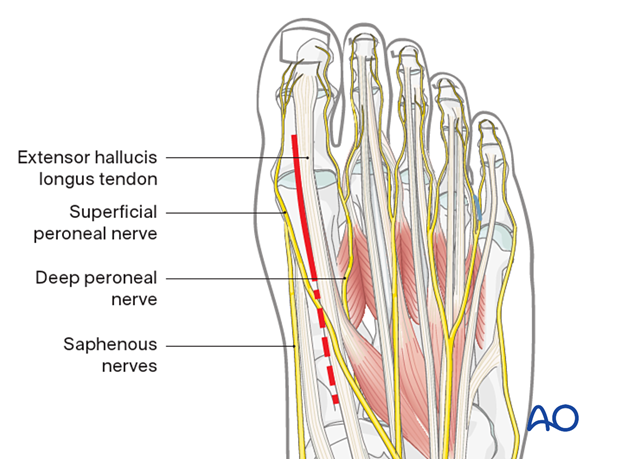 A010 dorsal approach to the first metatarsal phalangeal joint mtpj