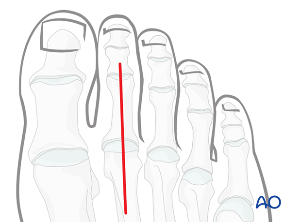 Dorsal approach to the proximal phalanx