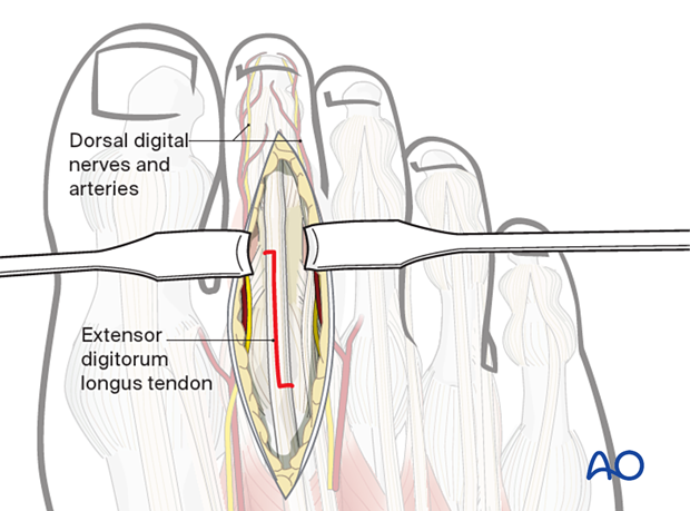 Z shape incision of the extensor tendon