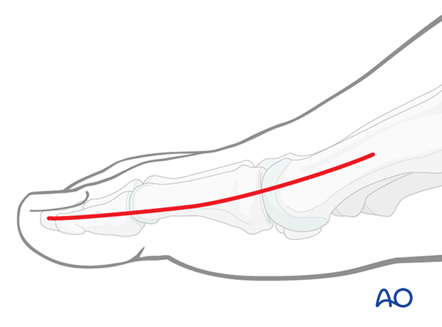 medial approach to the hallux