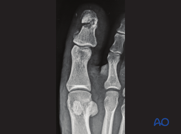 AP view of distal phalangeal fracture of the hallux
