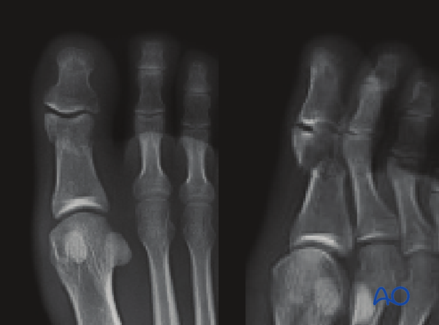 Intraarticular proximal phalanx fracture involving the interphalangeal joint