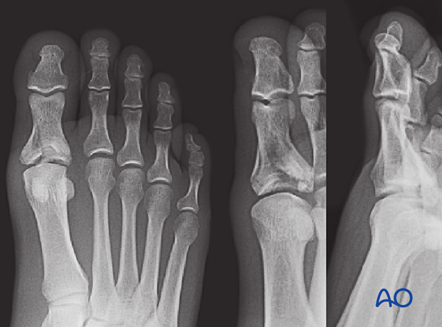 intraarticular proximal phalanx fracture involving the metatarsal phalangeal joint in both  AP and oblique view