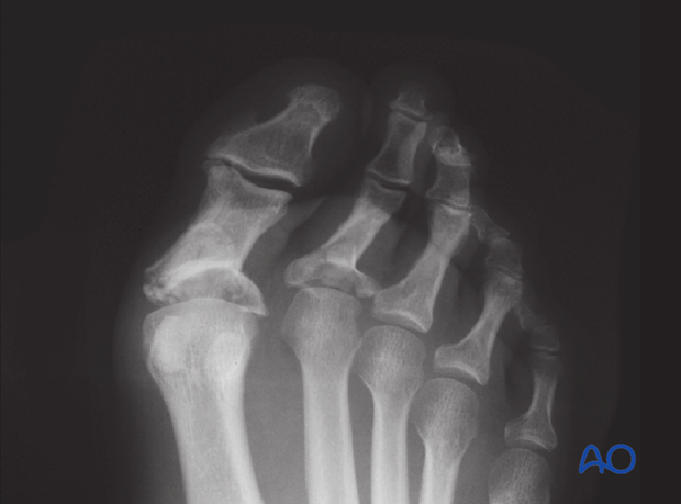 This image shows an x-ray of the comminuted base of the first and second proximal phalanges.