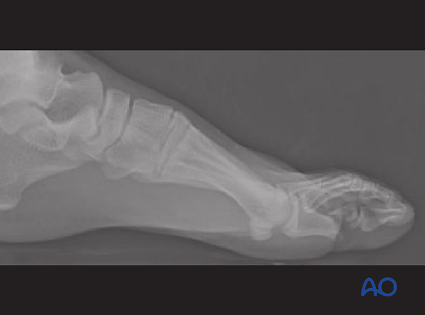 Lateral oblique X-ray