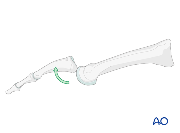 Dislocation of the mtp joint