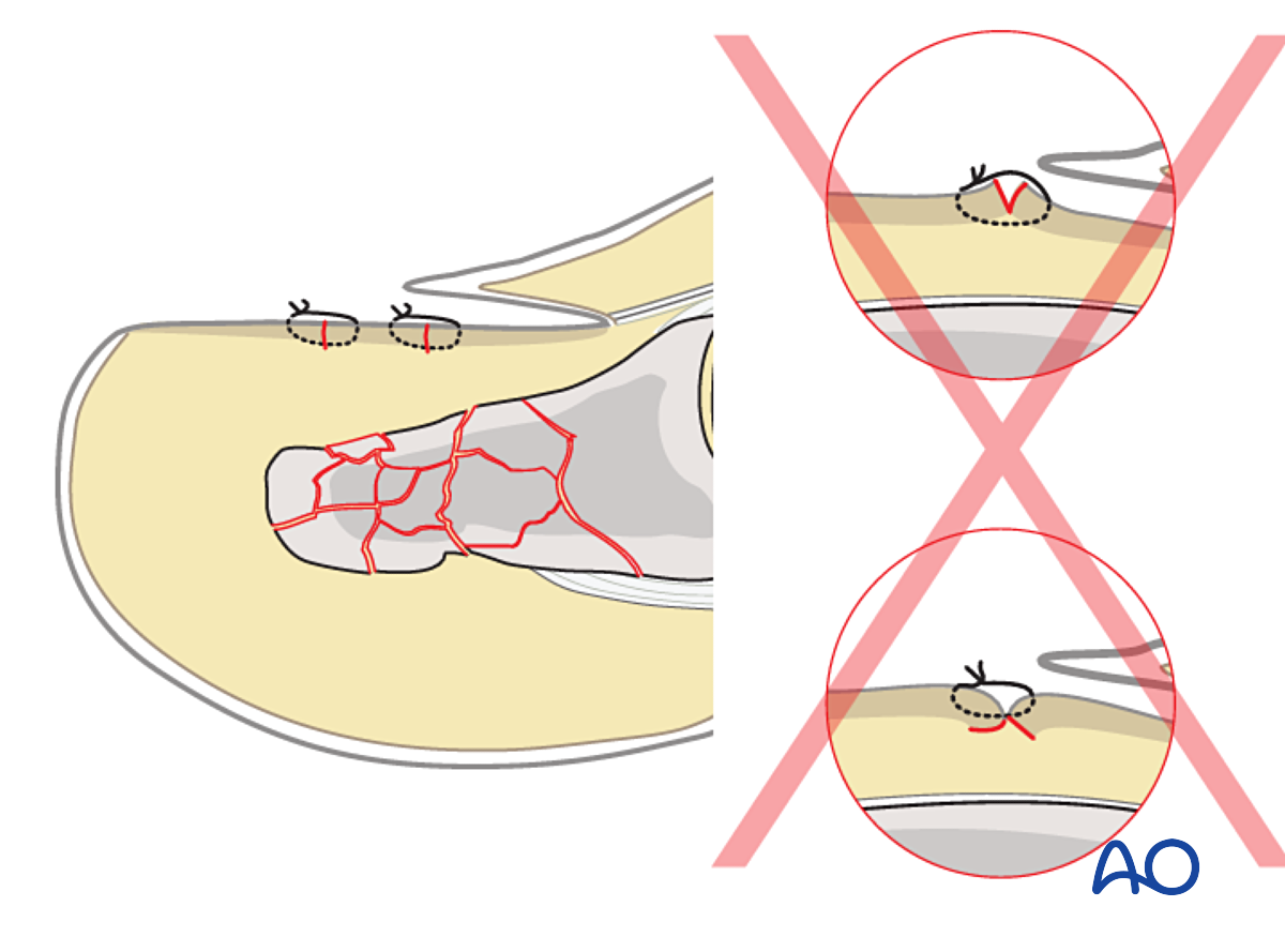 Top 130+ dermabond nail bed repair best ceg.edu.vn
