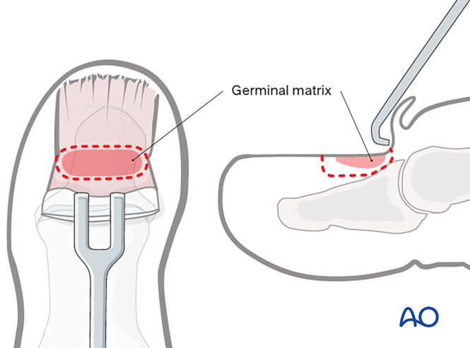 Toe Base Resection Nail bed excision for Lesser toe fractures
