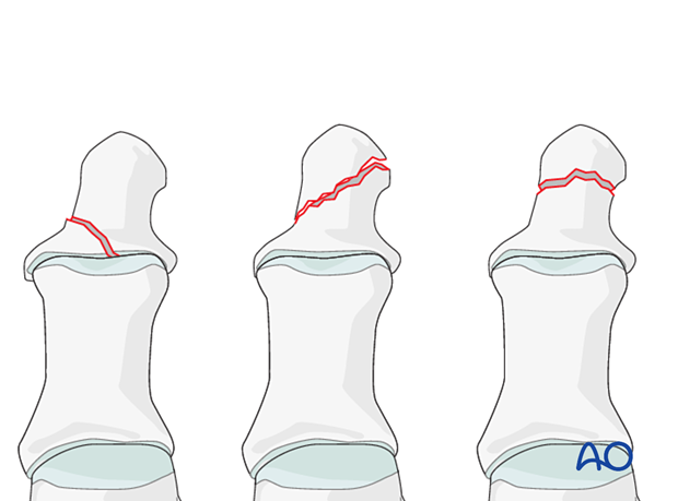 Distal hallux fracture patterns