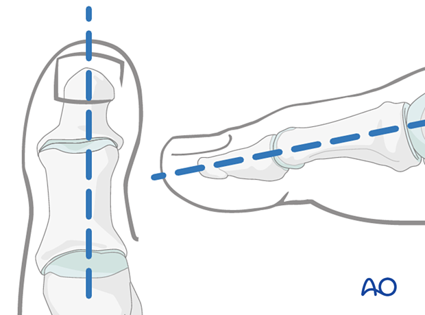 mark the K-wire's planned track with a skin marker on the distal phalanx in both the AP and the lateral aspects