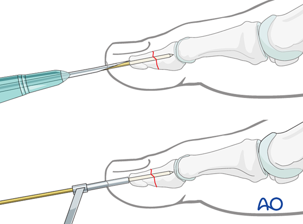 To prevent the K-wire from slipping during insertion, either a 16 gauge hypodermic needle or a drill guide can be used