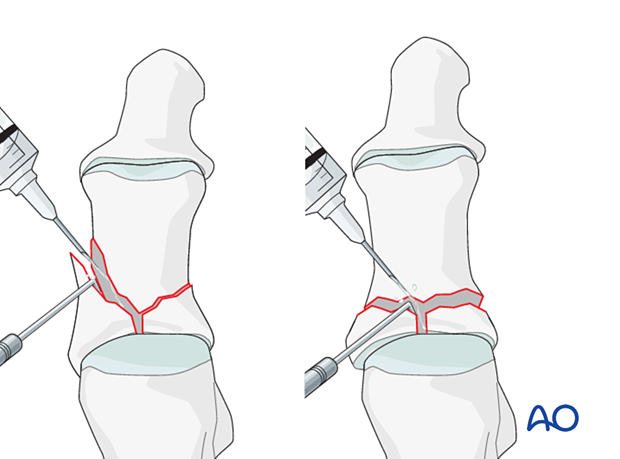 Debridement