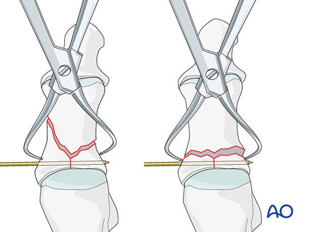 Temporary fixation using K-wire