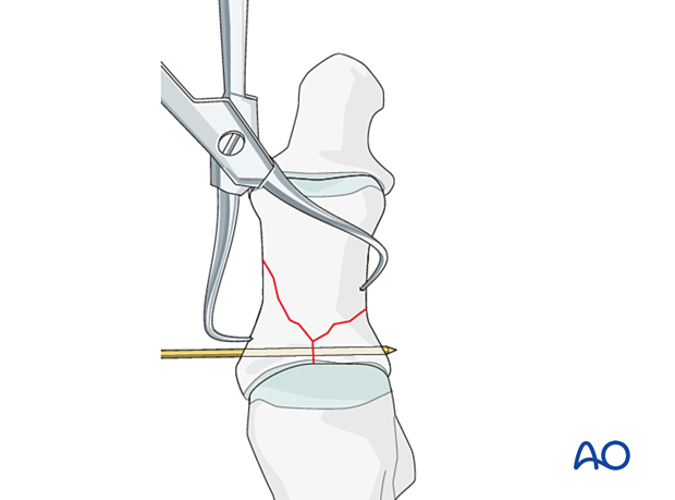 Reduction of the articular block to the shaft
