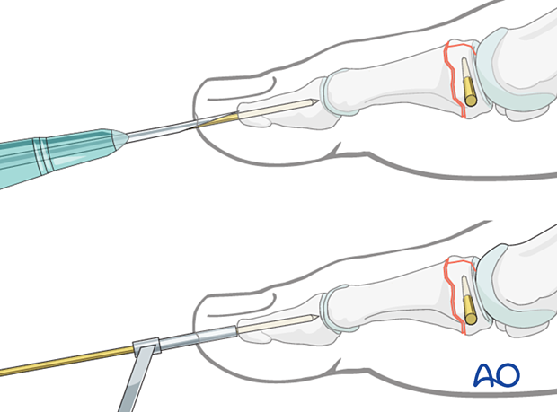 Axial K-wire insertion