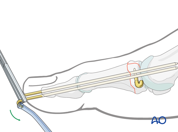 P103 K-wires