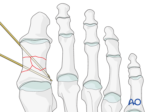 Medial wires in multifragmentary fractures