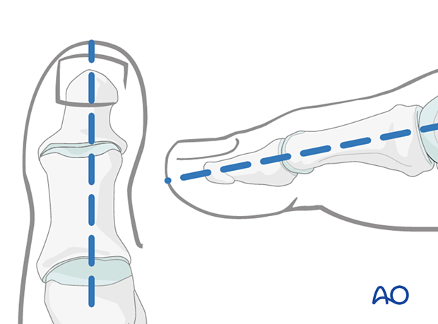 Markings for axial K-wires in the hallux