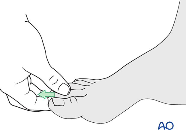 Indirect reduction of a distal extraarticular fracture of the 5th metatarsal