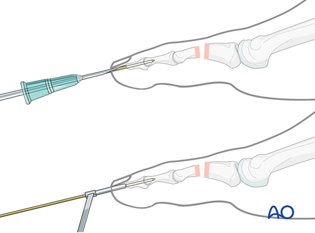 K-wire insertion into the distal phalanx