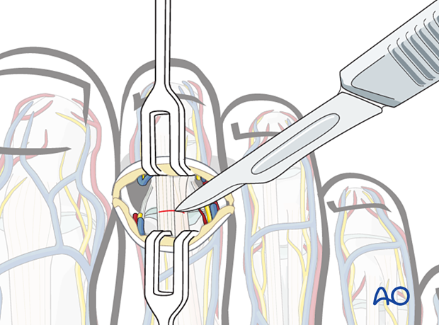 The extensor tendons are transected.