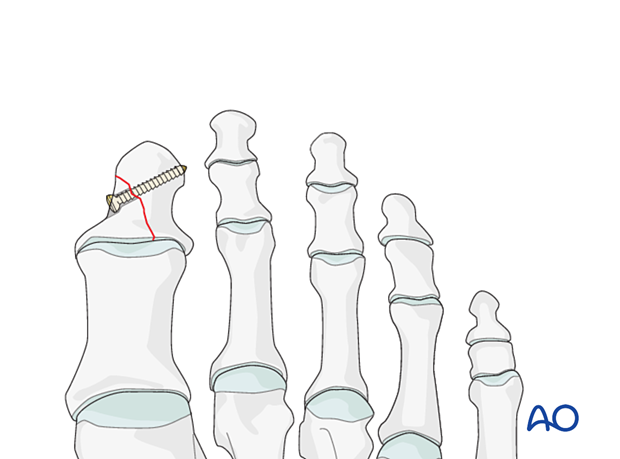 Lag screw fixation of distal phalanx fracture