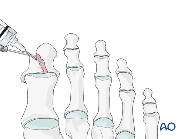 Irrigation of fracture