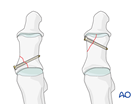 Lag screw fixation of proximal phalanx fracture