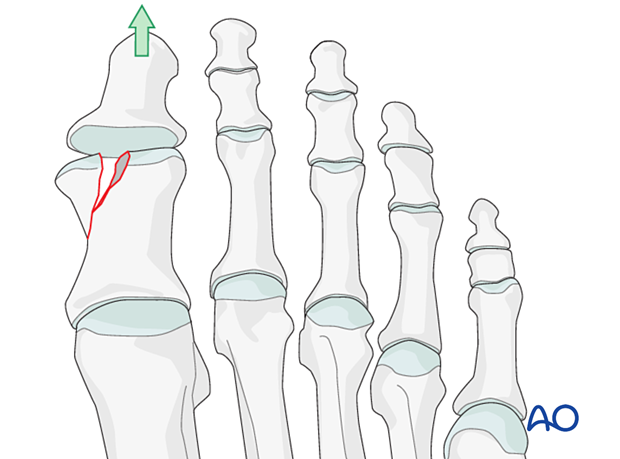 Visualization using traction