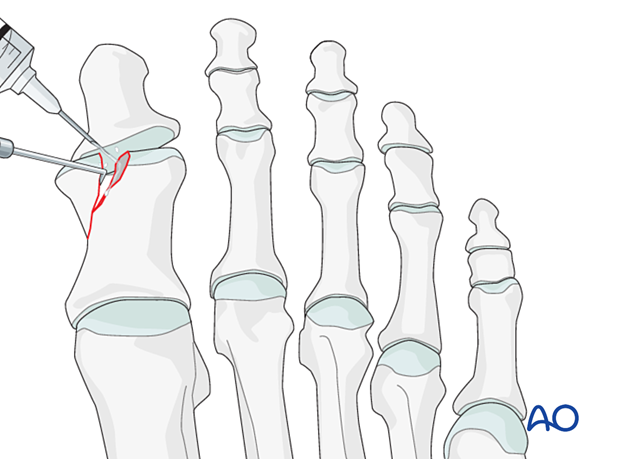 Irrigation of fracture