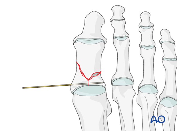 K-wire fixation of the articular block