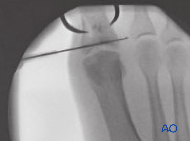 orif lag screws with or without plate