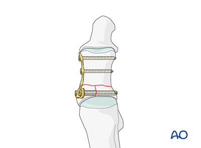 ORIF - Plate for Complete articular fractures of the proximal hallux