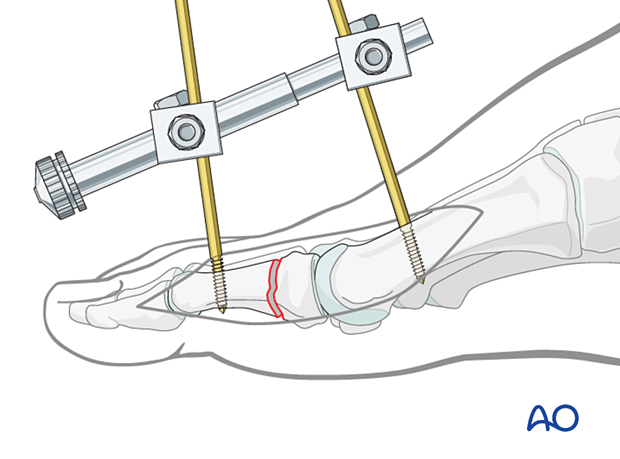 Use of a mini distractor to visualize a proximal phalangeal fracture