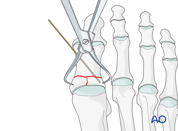Reduction of the articular block to the shaft