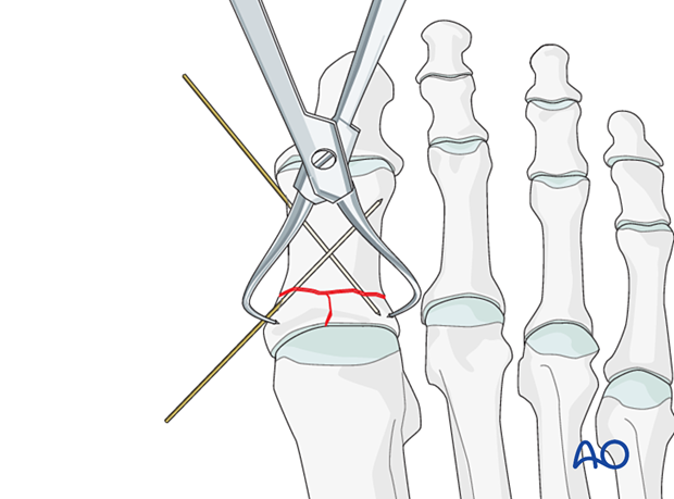 Fixation of the articular block to the shaft