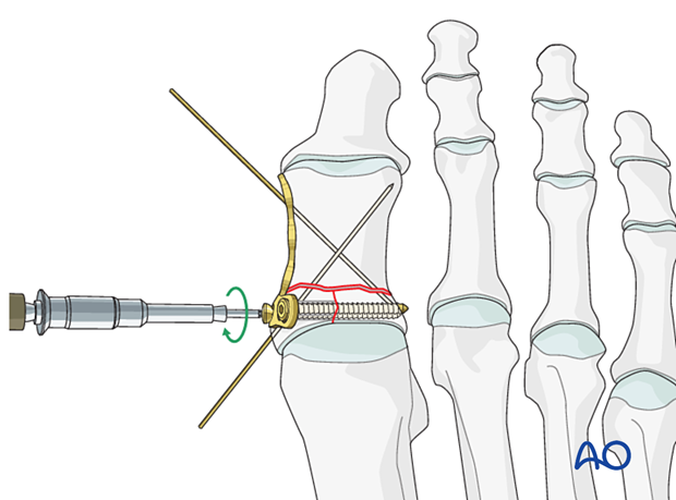 Fixation of the articular block with lag screws