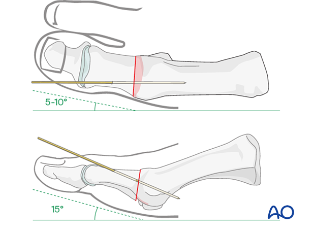 Correct positioning of the hallux