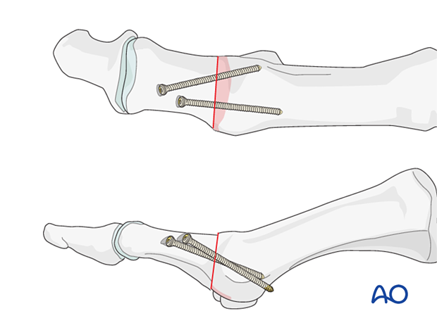 P320 mtp joint fusion of the hallux