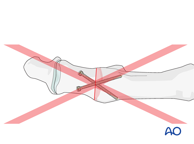 P320 mtp joint fusion of the hallux