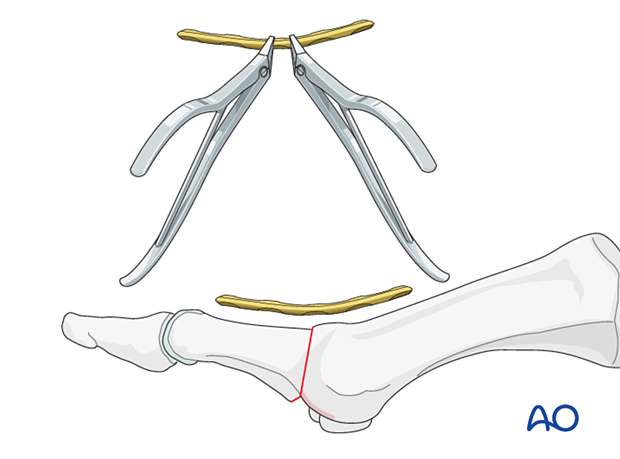 P320 mtp joint fusion of the hallux