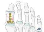 Plate application to comminuted fracture