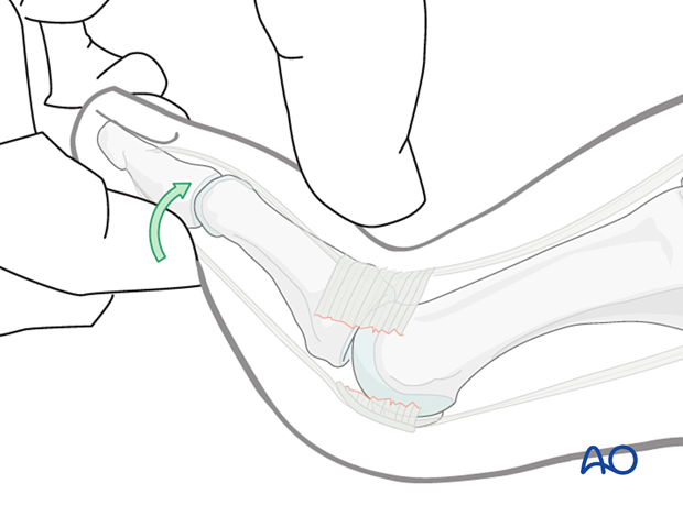 Reduction of MTP dislocation