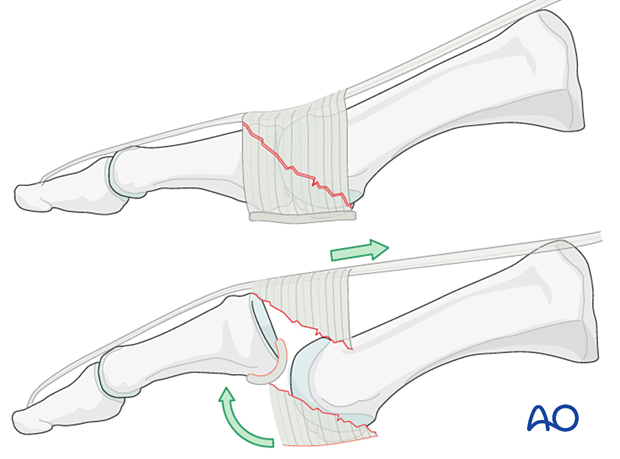The interposition of the plantar plate