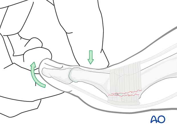 Reduction of the MTP joint