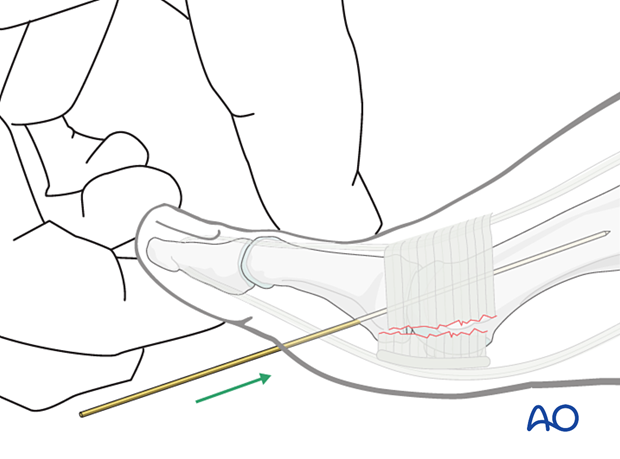 Insertion of K-wire through proximal phalanx and into the base of the metatarsal shaft