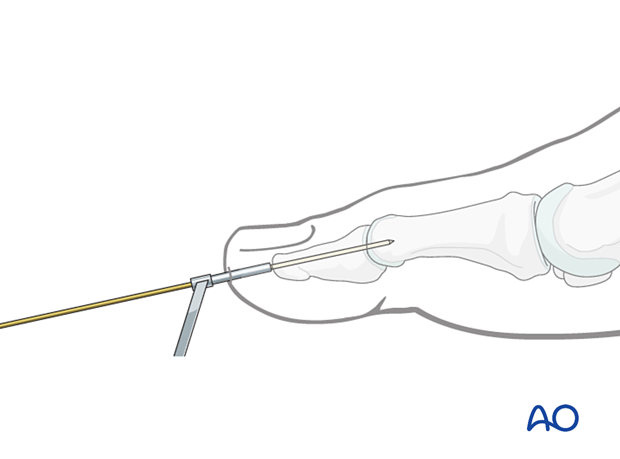 K-wire insertion into the distal phalanx